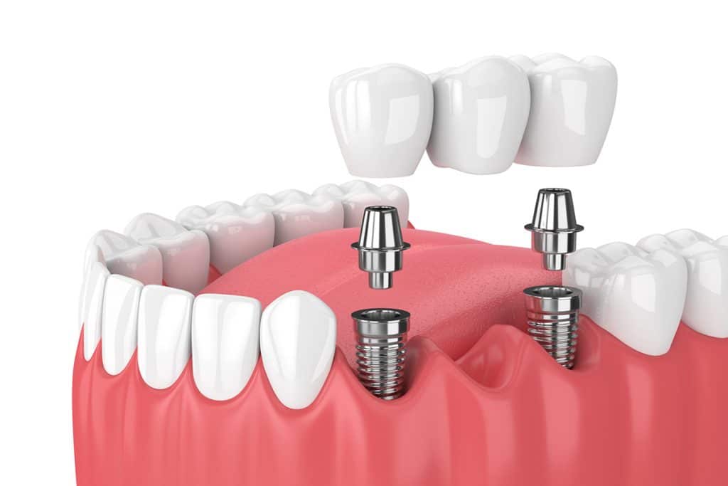 How Dental Bridges Compare to Implants for Replacing Missing Teeth