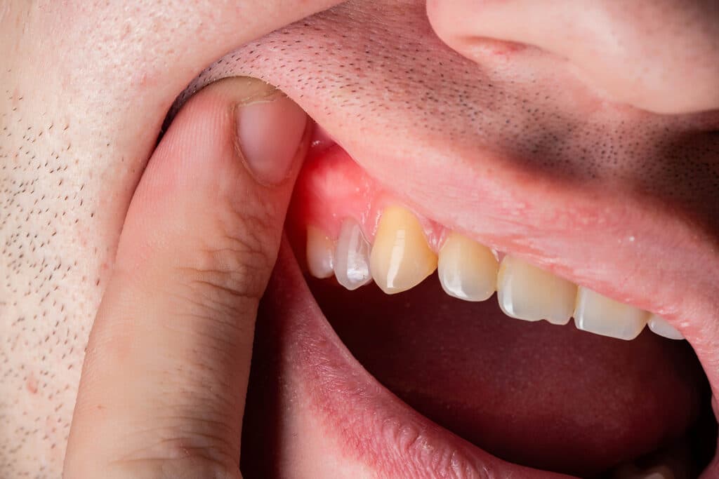 How Gum Disease Impacts Overall Health and How to Prevent It