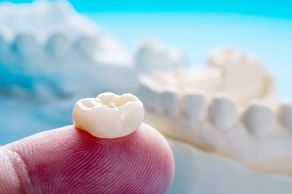 Same Day Crowns vs. Traditional Crowns: Pros and Cons