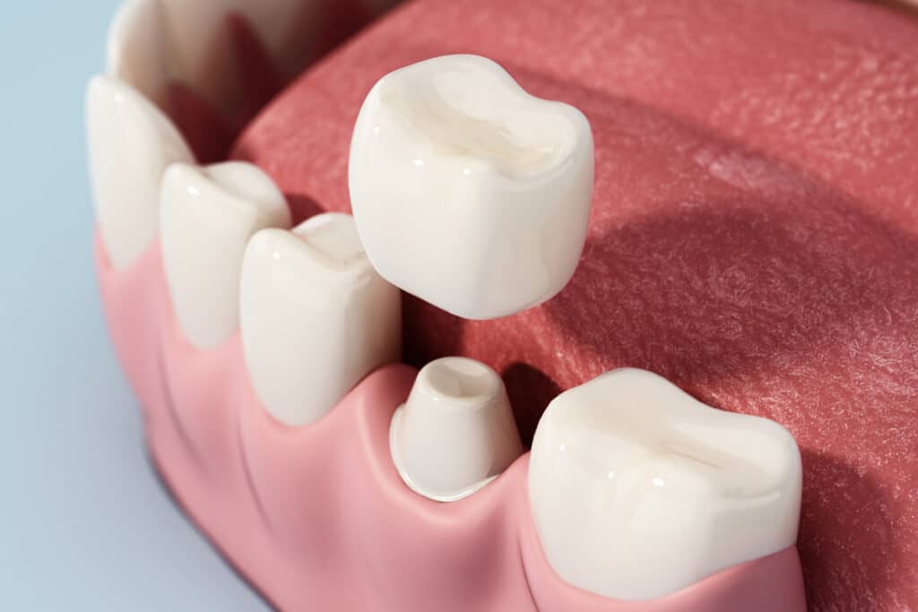 Signs You Might Need a Dental Crown Sooner Than You Think