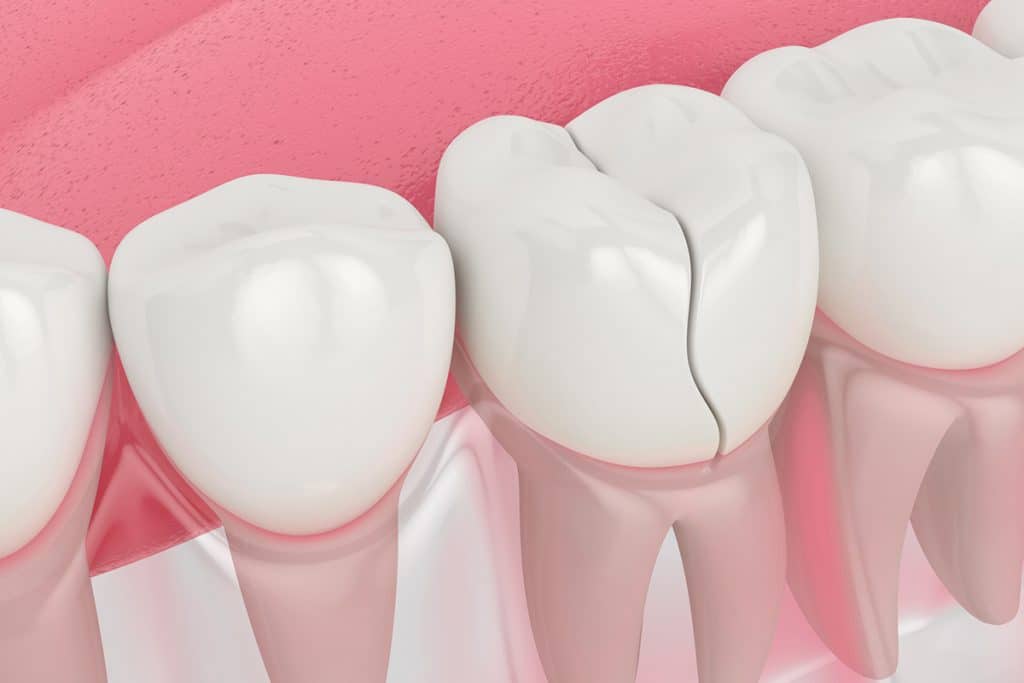 The Benefits of Dental Bonding for Restoring Chipped or Cracked Teeth